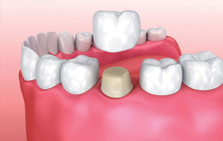 Treatment - Centre Point Dental